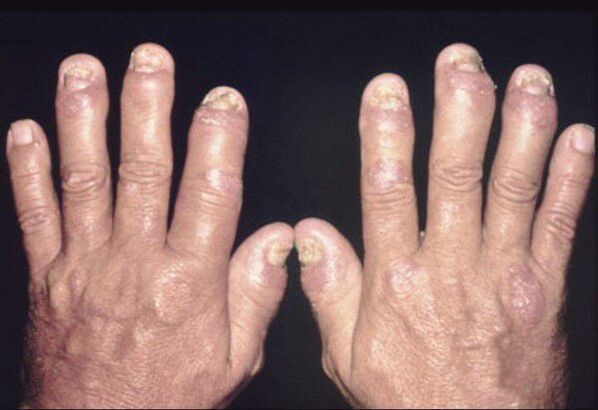 Στις αρθρώσεις